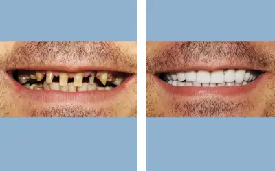 Before and After